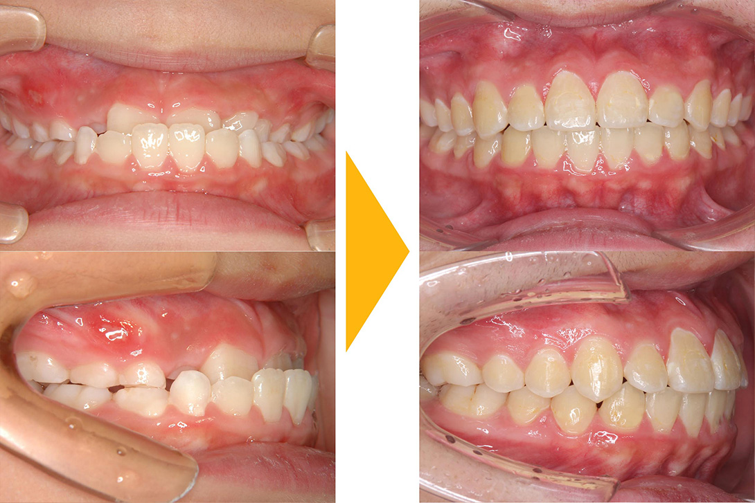 症例1：非抜歯矯正(下顎前突)