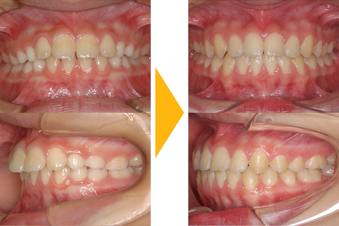 症例1：非抜歯矯正(出っ歯・上顎前突)