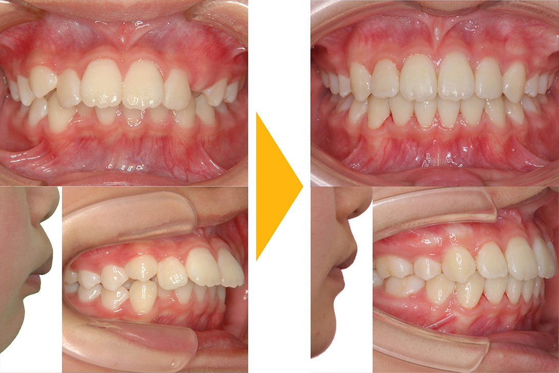 症例2：抜歯矯正(出っ歯・上顎前突)