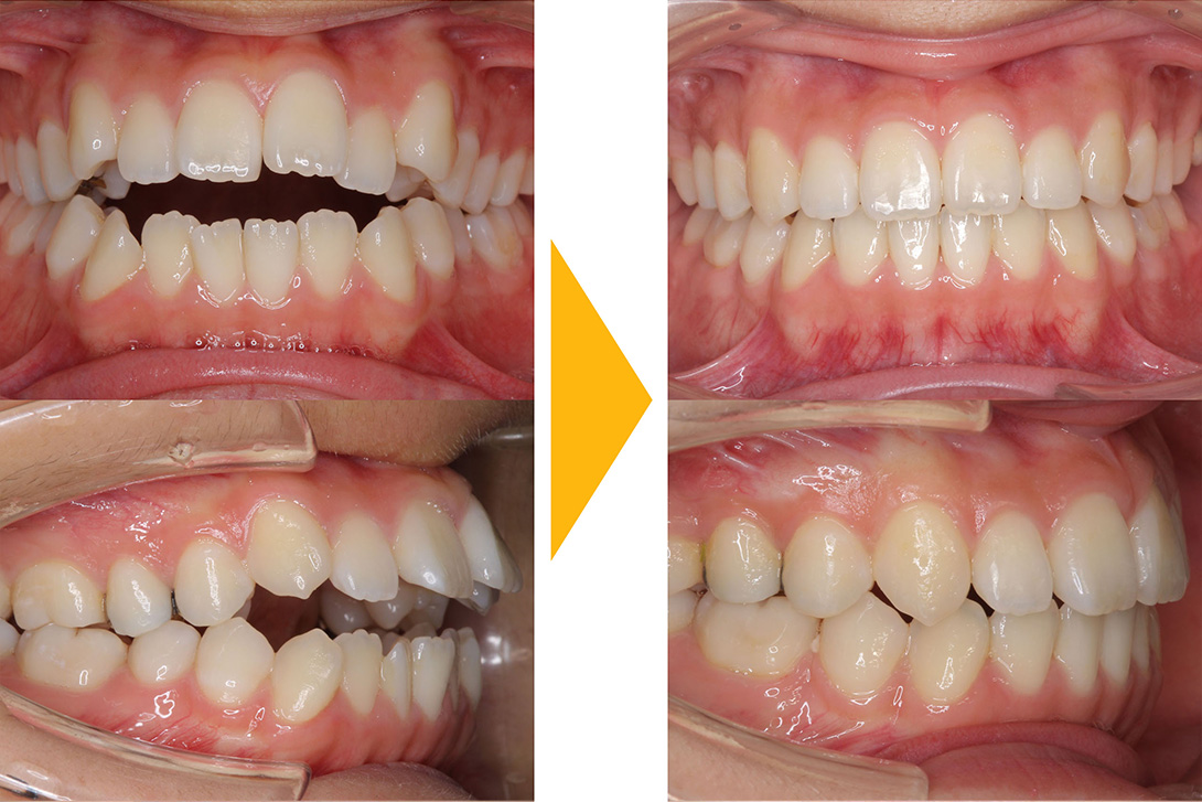 症例1：抜歯矯正(前歯で噛めない・開咬)