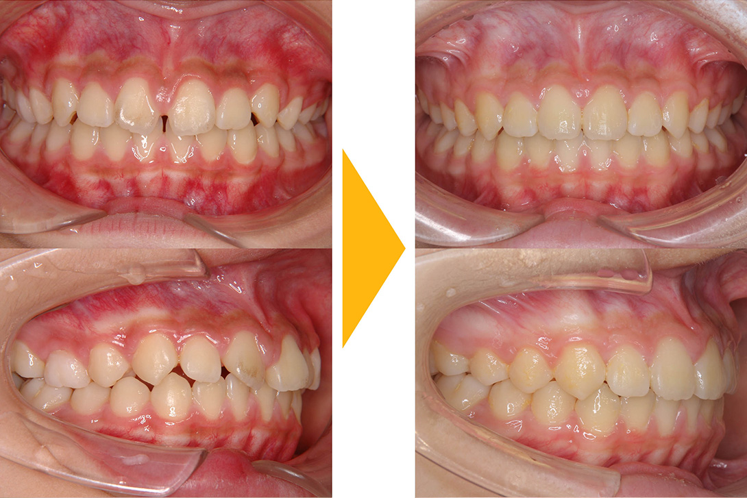 症例1：非抜歯矯正(すきっぱ・正中離開)