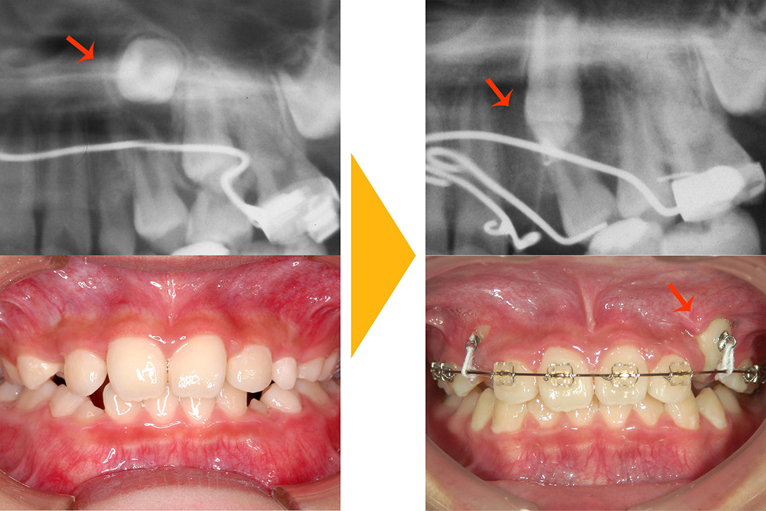 症例1：非抜歯矯正(歯が生えてこない・埋伏)