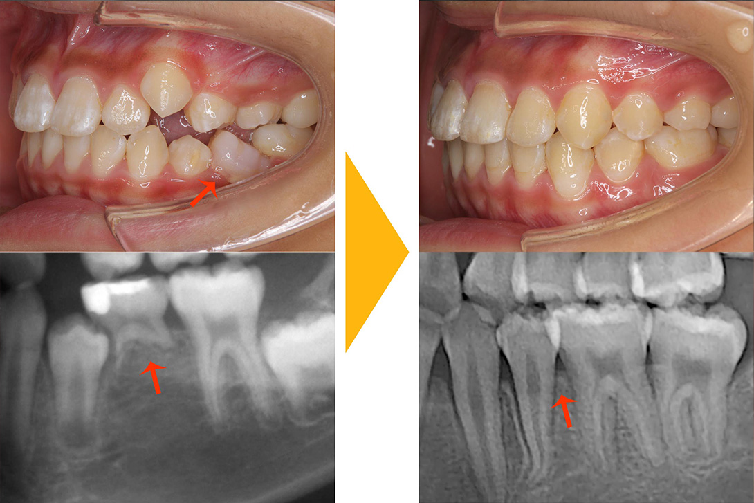 症例1：抜歯矯正(永久歯が少ない・先欠)