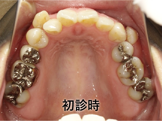 ②むし歯治療