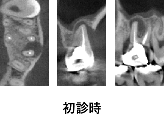 ③根管治療・再根管治療