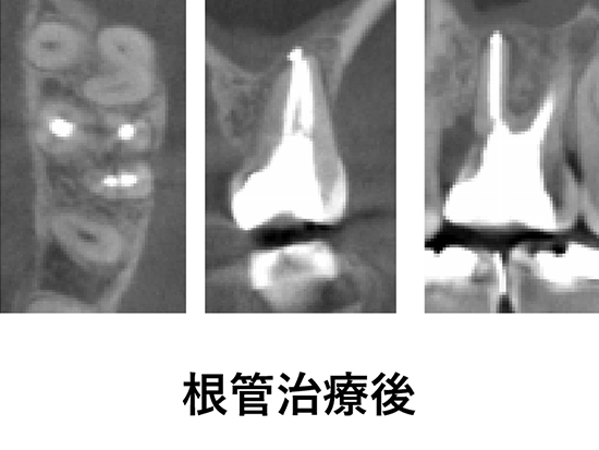 ③根管治療・再根管治療