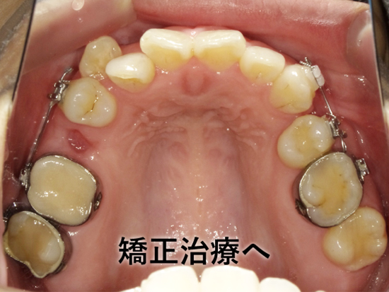 ③根管治療・再根管治療