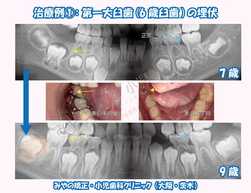 治療例①：第一大臼歯(6歳臼歯)の埋伏