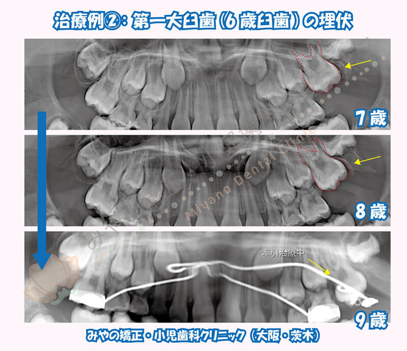 治療例②：第一大臼歯(6歳臼歯)の埋伏