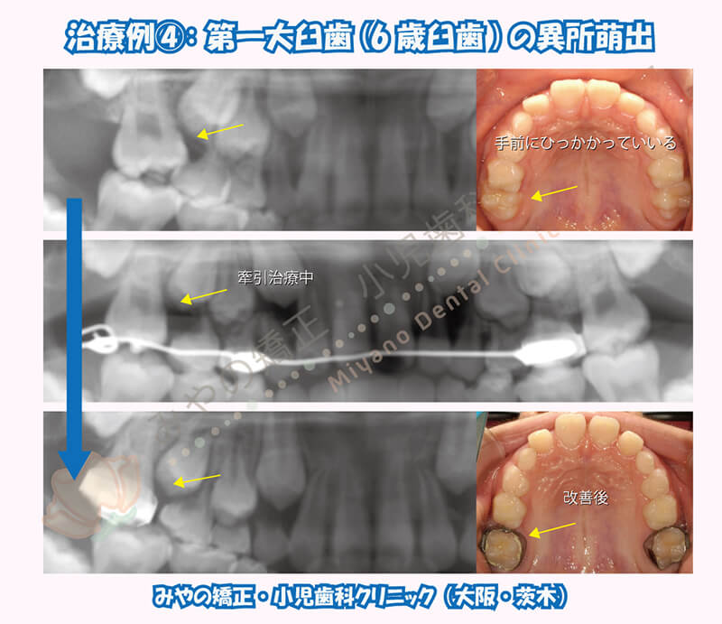 治療例④：第一大臼歯(6歳臼歯)の異所萌出
