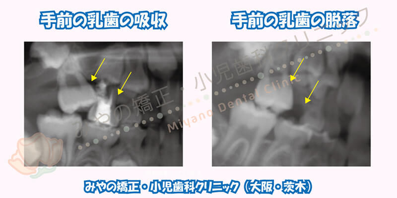 治療例④：第一大臼歯(6歳臼歯)の異所萌出