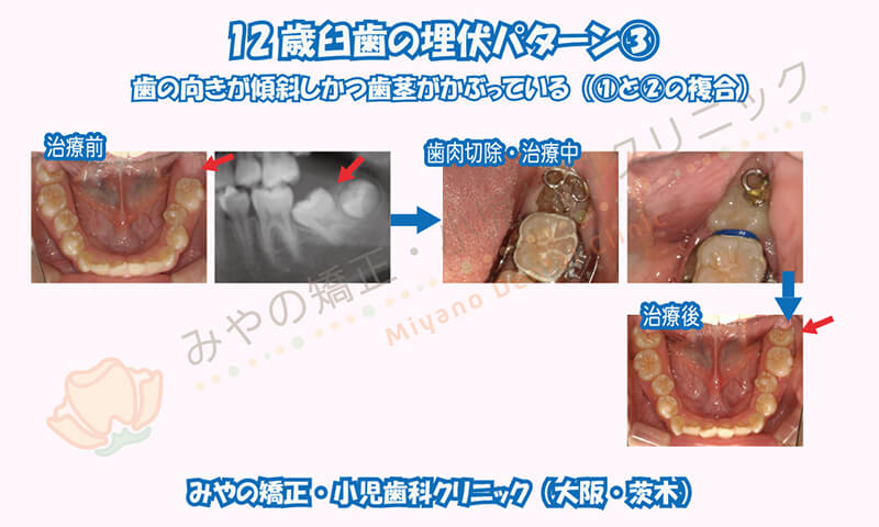 12歳臼歯の埋伏③歯の向きが傾斜し、かつ歯茎がかぶっている（①と②の複合）