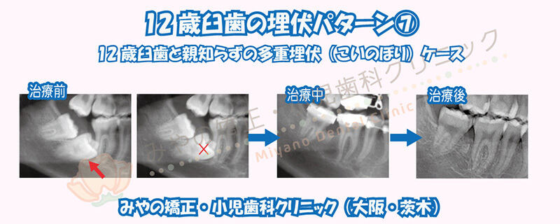 12歳臼歯の埋伏⑦12歳臼歯と親知らずの多重埋伏（こいのぼり）ケース