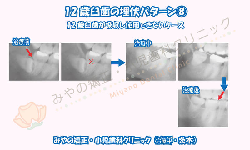 12歳臼歯の埋伏⑧12歳臼歯が吸収し使用できないケース