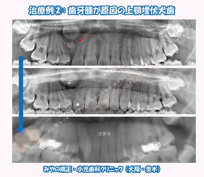 犬歯埋伏治療例②：歯牙腫が原因の上顎埋伏犬歯