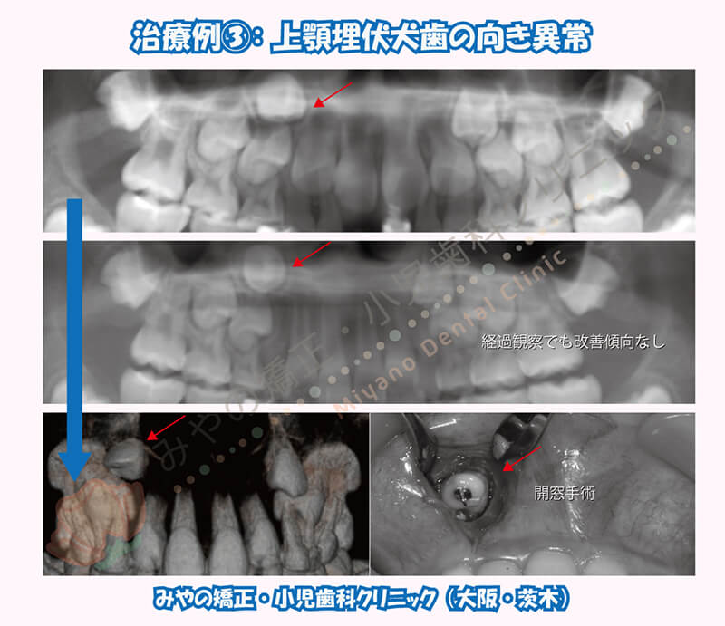 犬歯埋伏治療例③：上顎埋伏犬歯の向き異常