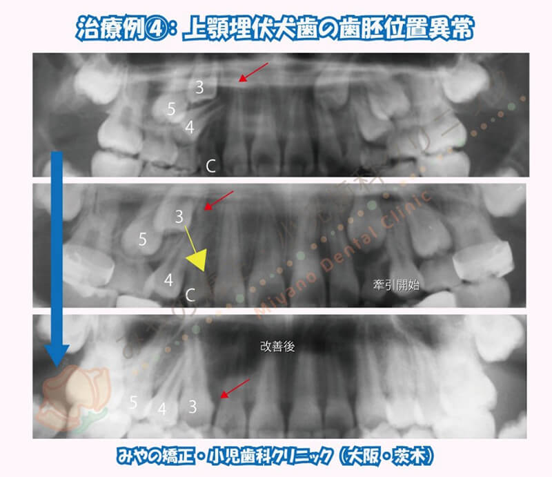 犬歯埋伏治療例④：上顎埋伏犬歯の歯胚位置異常