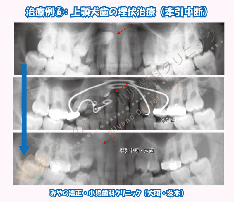 犬歯埋伏治療例⑥：上顎犬歯の埋伏治療（牽引中断）