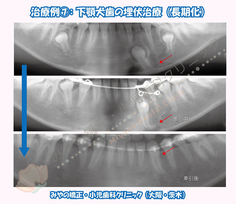 犬歯埋伏治療例⑦：下顎犬歯の埋伏治療（長期化）