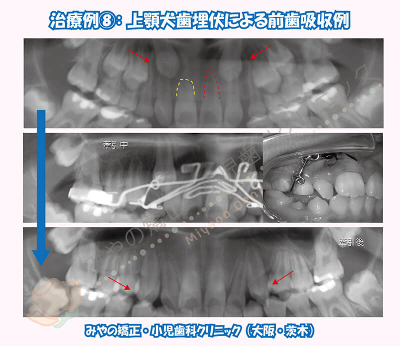 犬歯埋伏治療例⑦：下顎犬歯の埋伏治療（長期化）