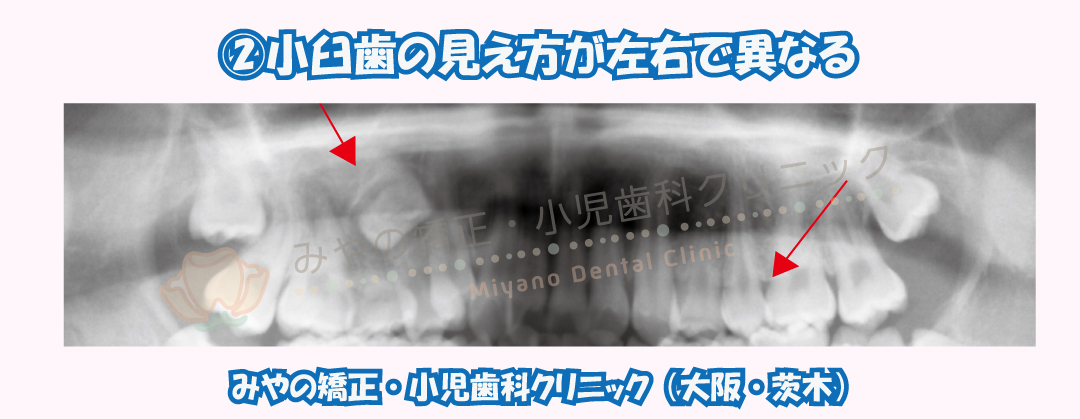②小臼歯の見え方が左右で異なる