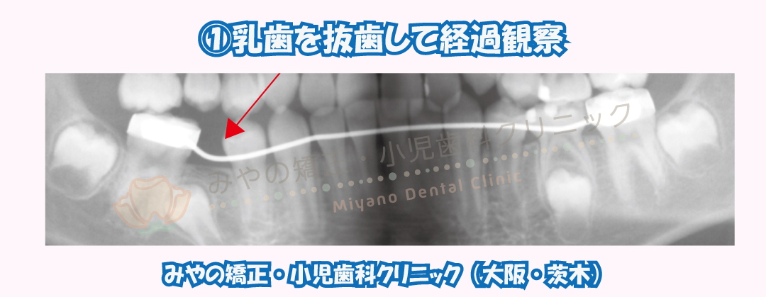 ①乳歯を抜歯して経過観察
