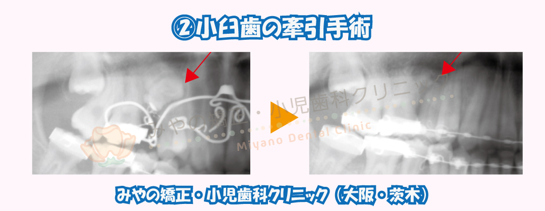 ③埋伏小臼歯の抜歯